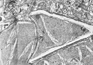 F,15y. | infantile neuroaxonal dystrophy (Seitelberger) F,15y. | infantile neuroaxonal dystrophy (Seitelberger)